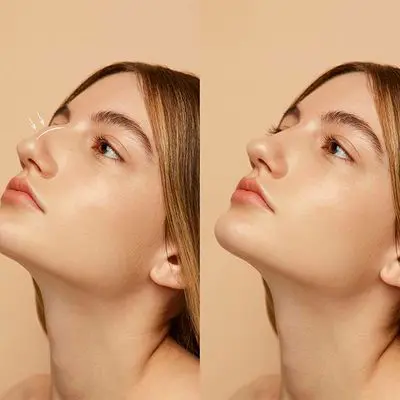 Nose Fillers